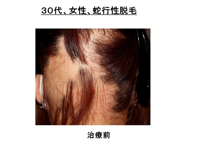 円形脱毛症　病院